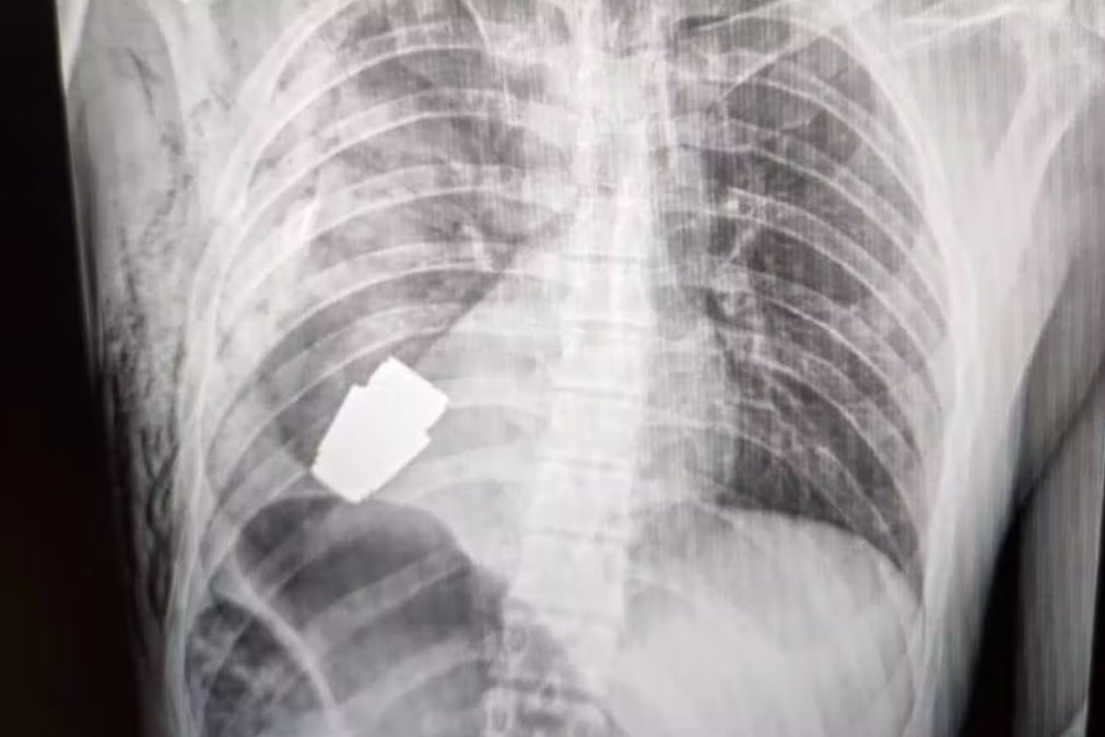 烏克蘭軍醫(yī)從士兵軀干上取出未爆炸的手榴彈