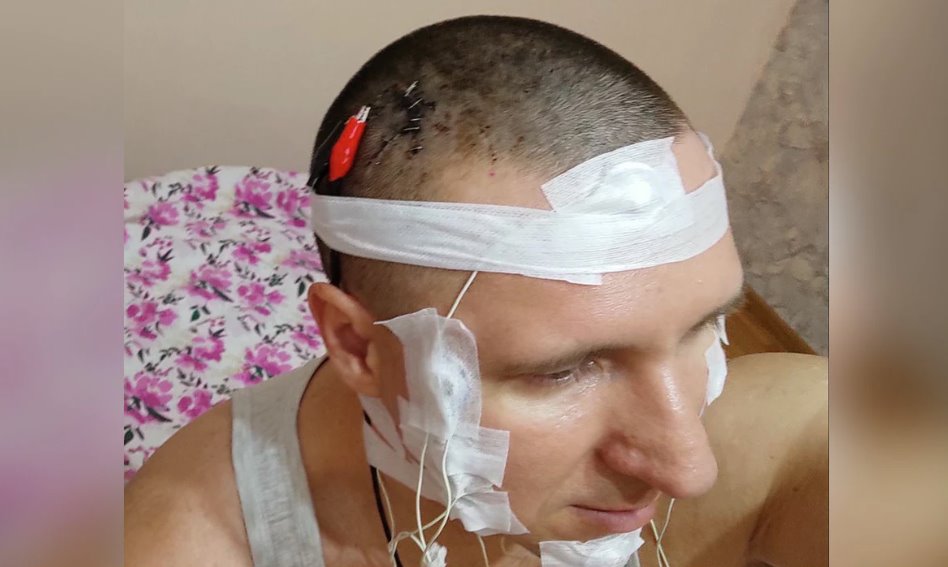 俄羅斯男子在家給自己做腦補植入芯片手術(shù)差點喪命